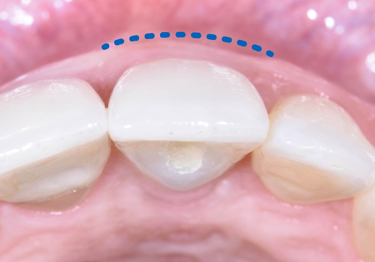 Loose gum tissue patient procedure step 2