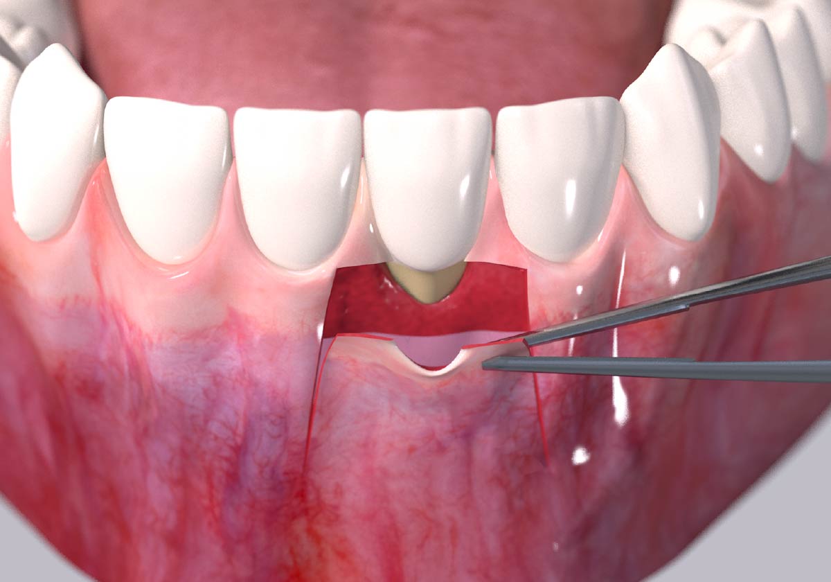 Receding gums surgical procedure step 2