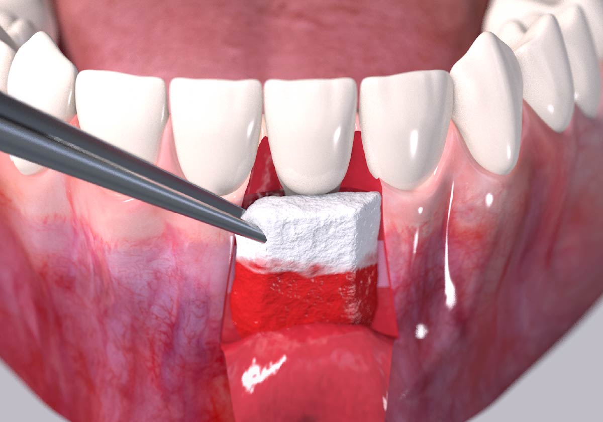 Receding gums surgical procedure step 3